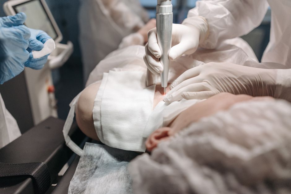 Acne Scar Removal