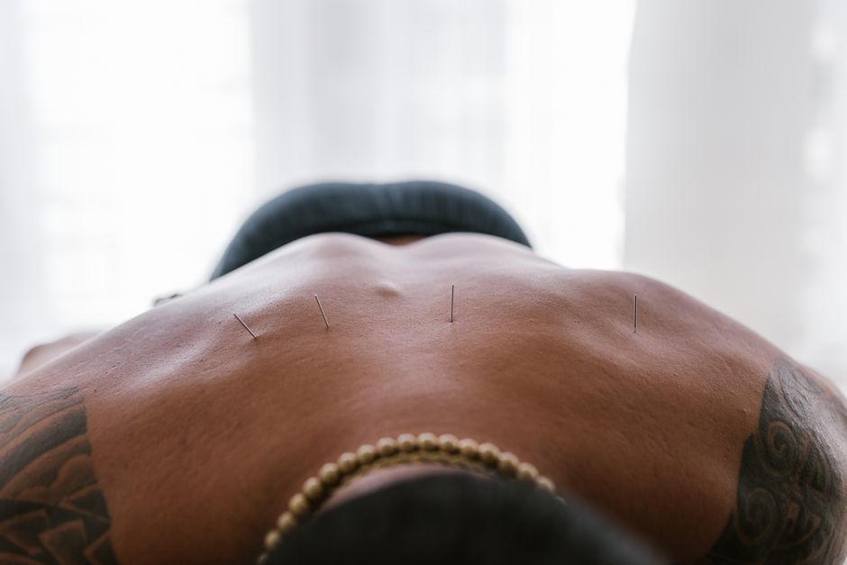 Acupuncture Treatment