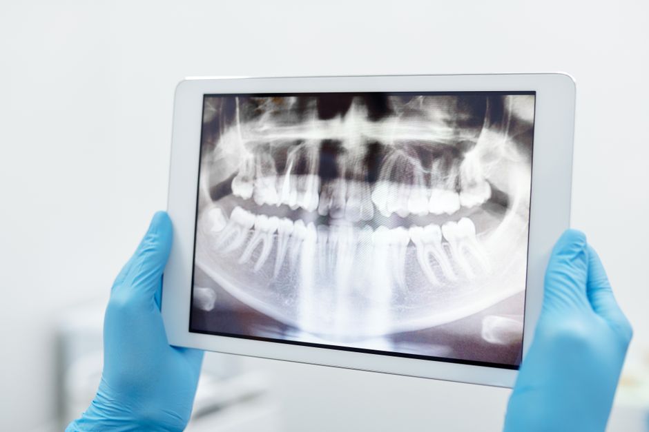 Dentist reviewing a 3D CBCT scan on a computer screen during a digital guided implant surgery consultation in Korea