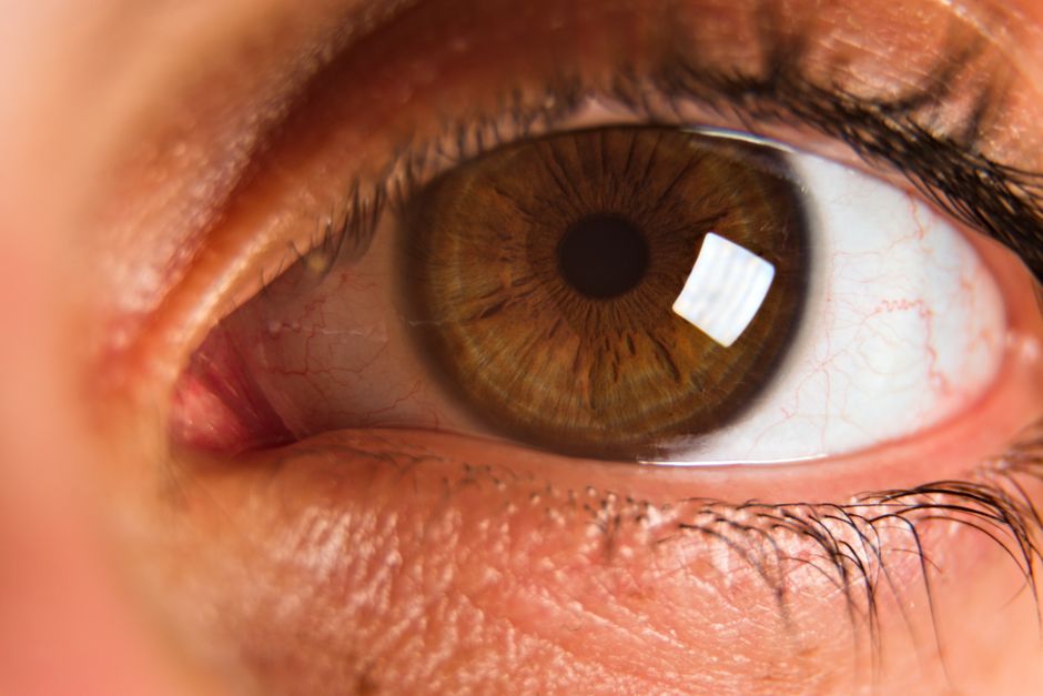 LASEK surface laser vision correction at Korean eye clinic