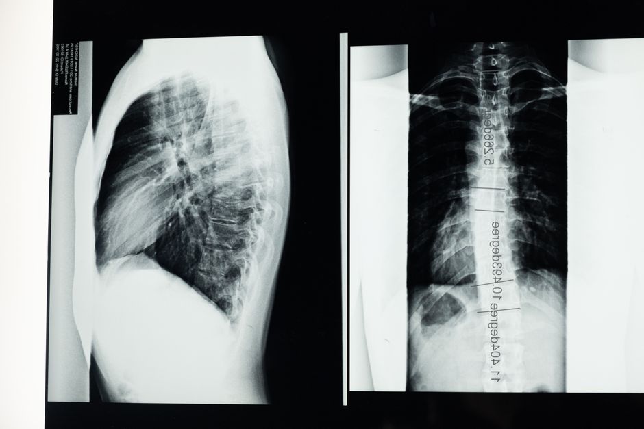 Scoliosis Correction Surgery