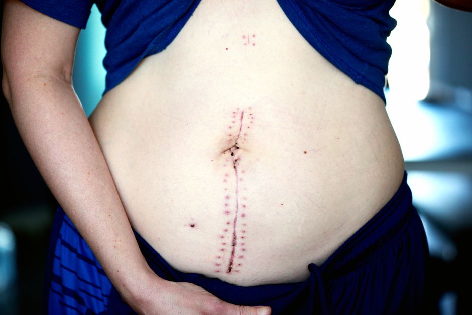 Tummy Tuck